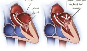 عملية ارتجاع الصمام الميترالي
