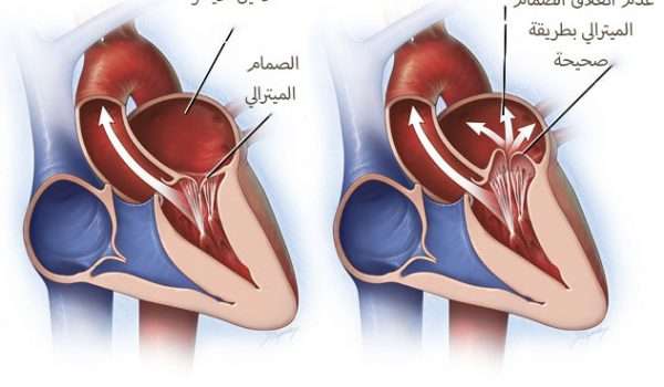 عملية ارتجاع الصمام الميترالي